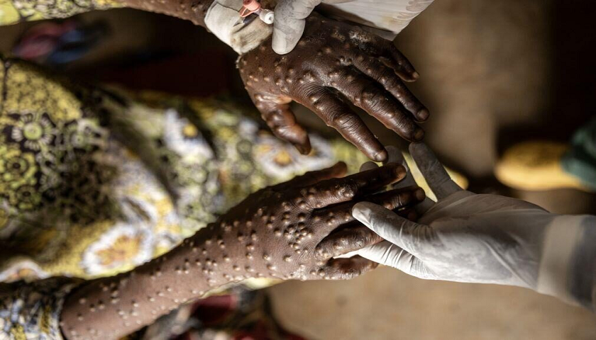 MPOX NO UÍGE E ALERTA NO ZAIRE
